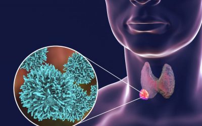 Prise en charge du cancer de la thyroïde : nouvelles recommandations