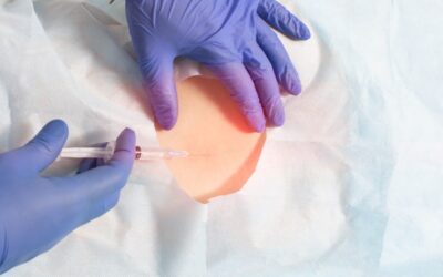 mastectomie partielle traitement du cancer du sein